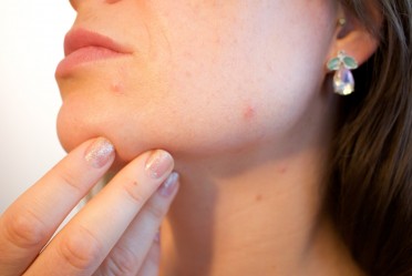 Olilab - Na koji način nastaju akne na licu i njihovo uklanjanje