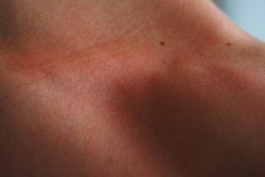 Olilab - Atopijski dermatitis