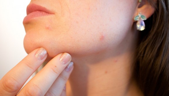 Na koji način nastaju akne na licu i njihovo uklanjanje - Olilab