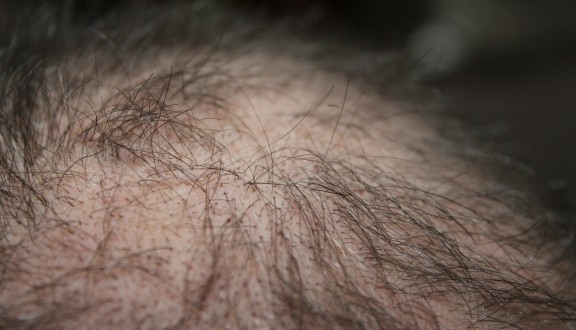 Alopecija - ispadanje kose - Olilab
