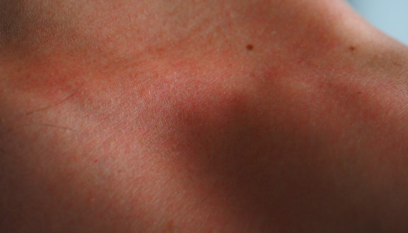 Atopijski dermatitis - Olilab