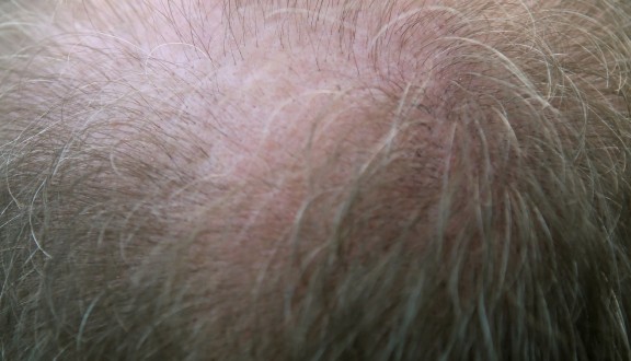 Perut u kosi: uzroci, simptomi i uklanjanje peruti - Olilab