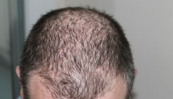 Najčešći zdravstveni razlozi ispadanja kose - Olilab
