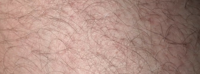 Olilab - Upala korijena dlake - folikulitis